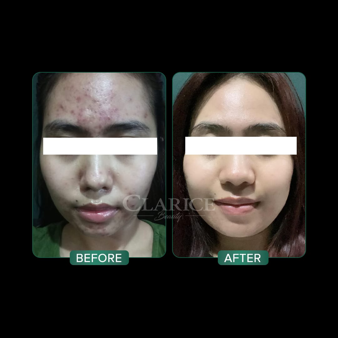 Dokter Kulit: Sebagian Besar Kasus Jerawat pada Remaja Dapat Disembuhkan Sepenuhnya